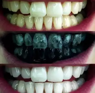 Blanqueador Dental de Carbón Activado secuencia